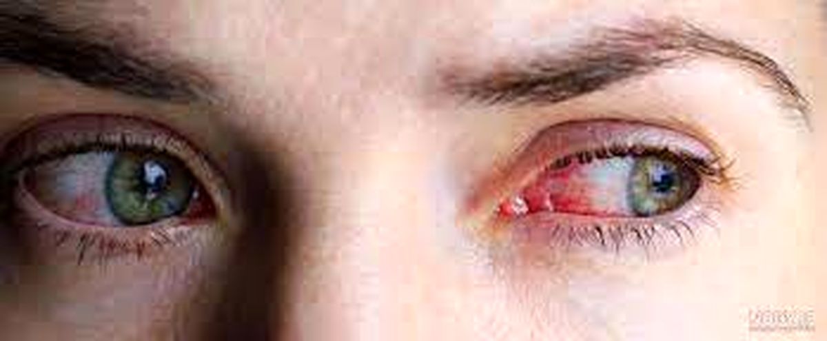 راز لکههای قرمز داخل چشم