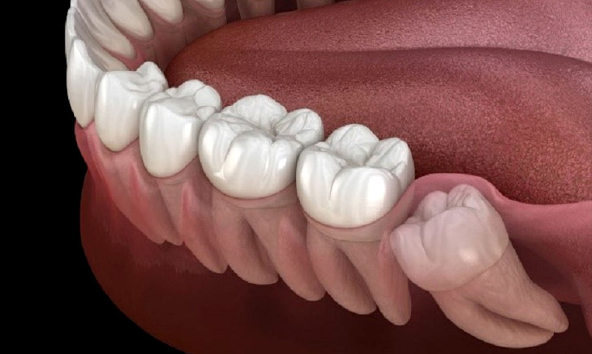 عوارض نکشیدن دندان عقل چیست؟ + فیلم