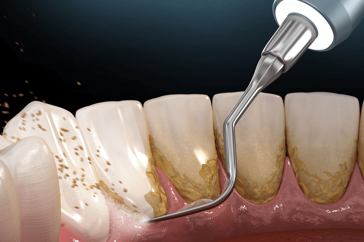 چرا باید دندان هایمان را جرم گیری کنیم؟